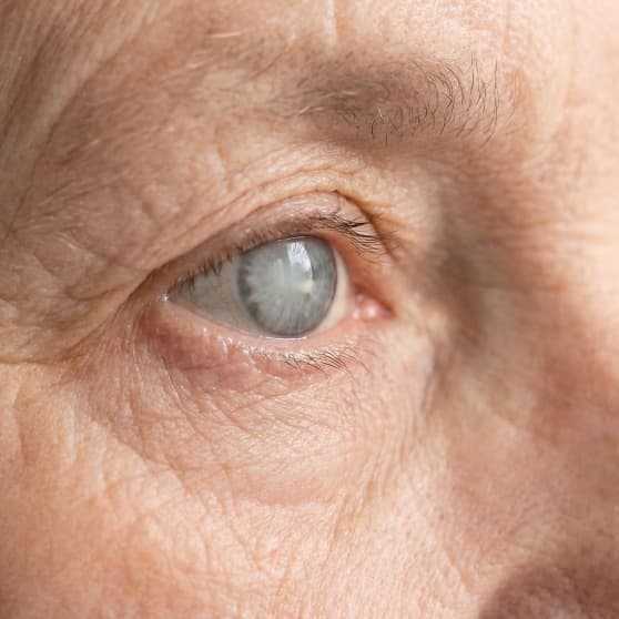 Cataract