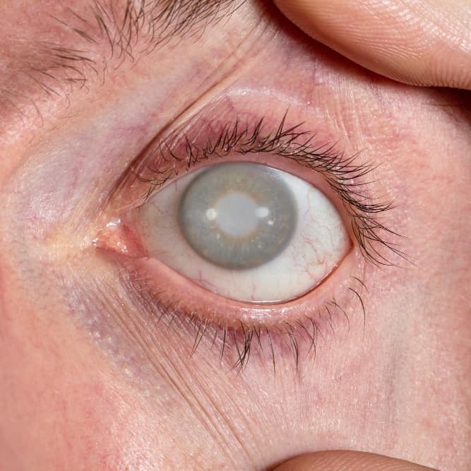 Glaucoma