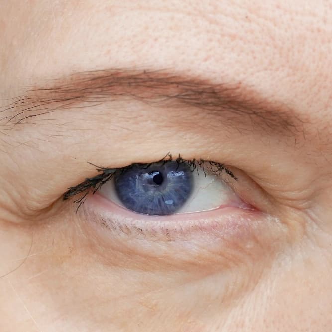 Ptosis (Eyelid Drooping)
