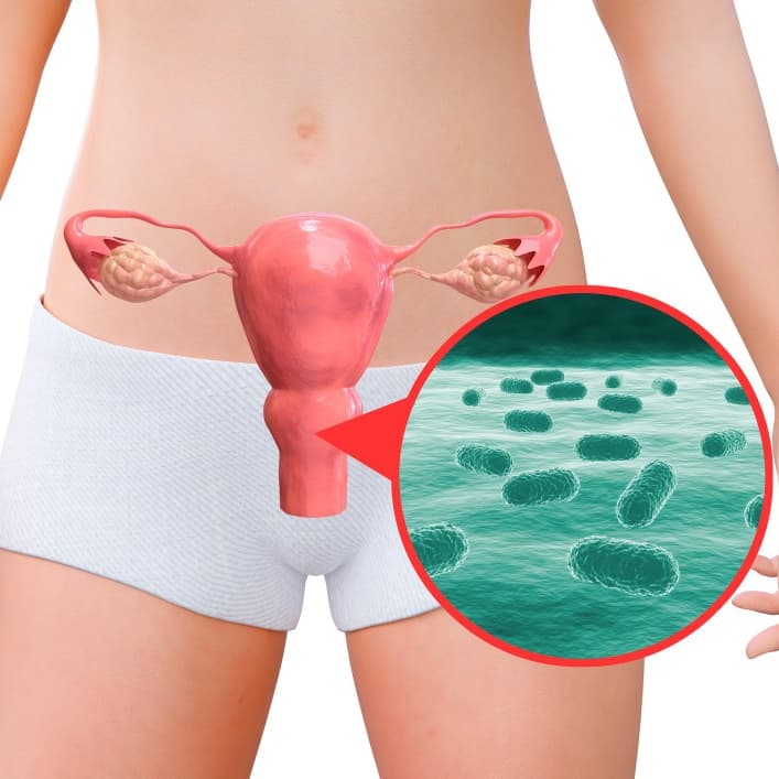 Bacterial Vaginosis
