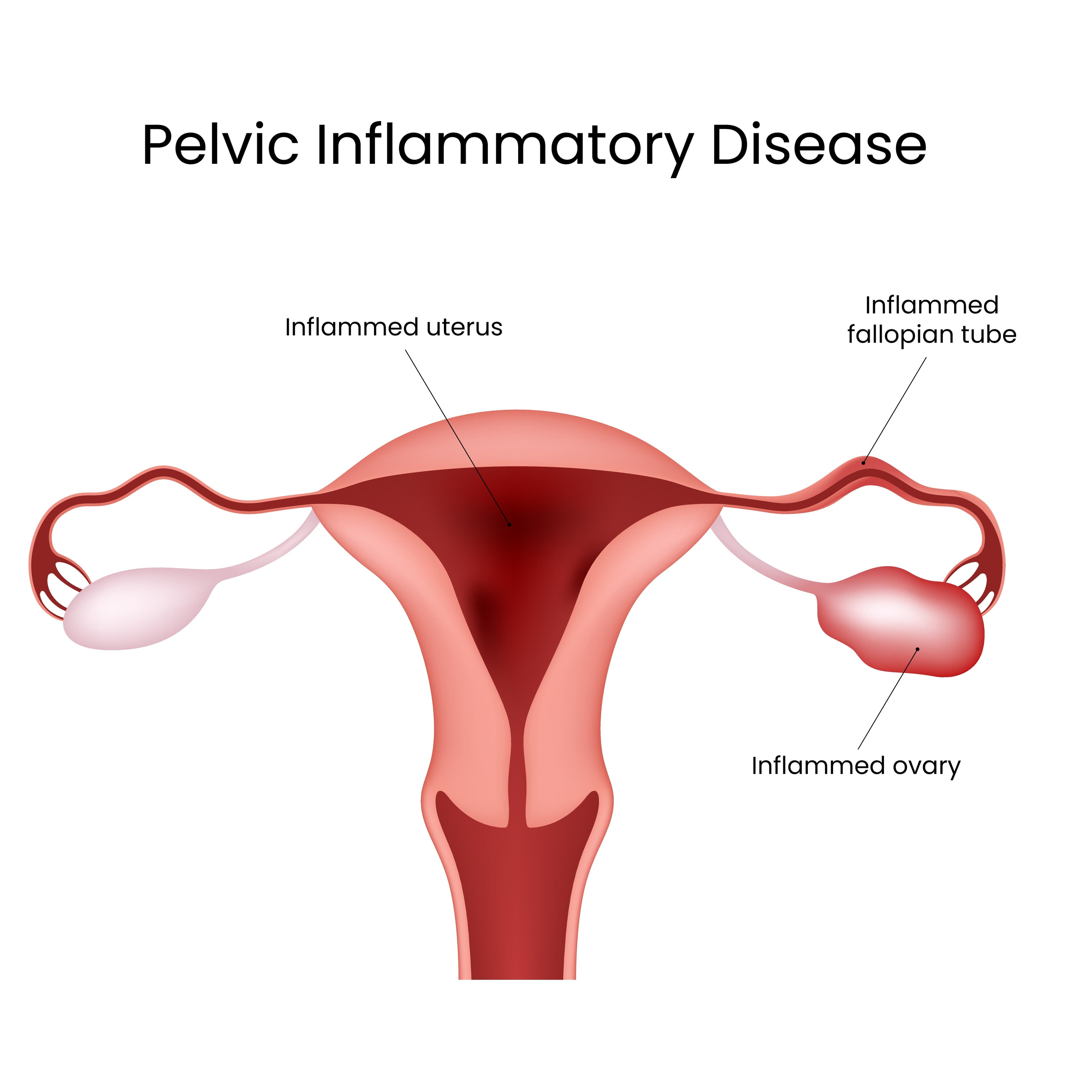 Pelvic Inflammatory Disease (PID)