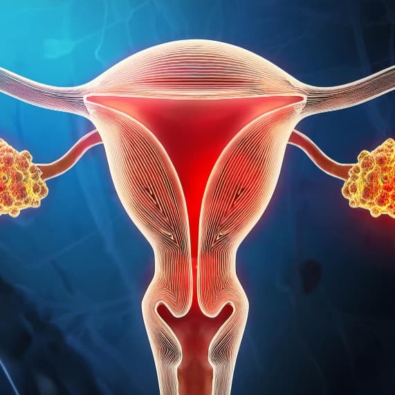 Chocolate Cyst (Endometrioma)