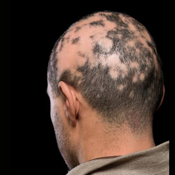 Alopecia Areata