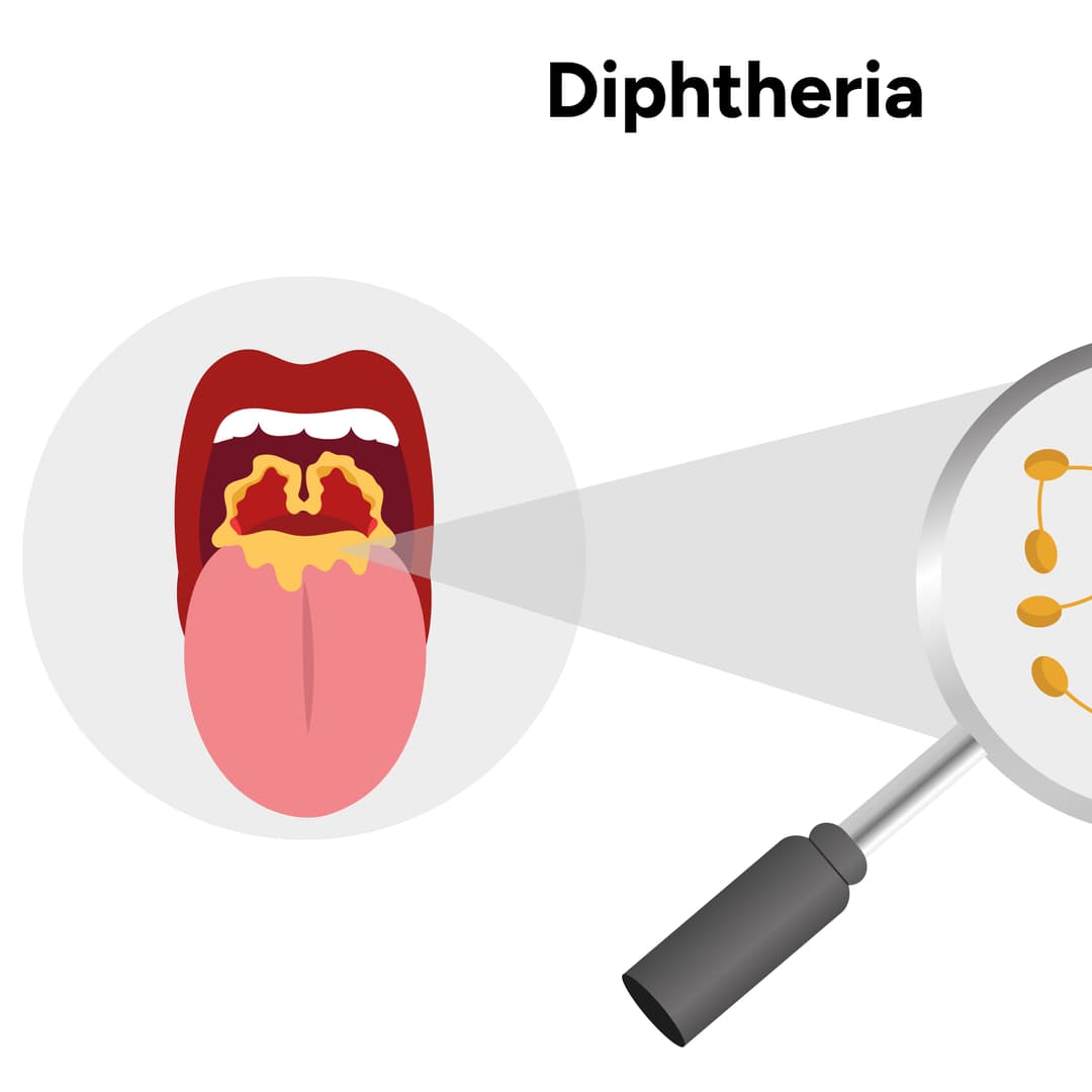 Diphtheria