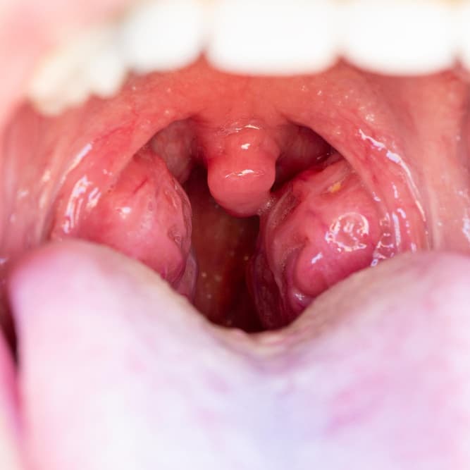 Tonsillitis