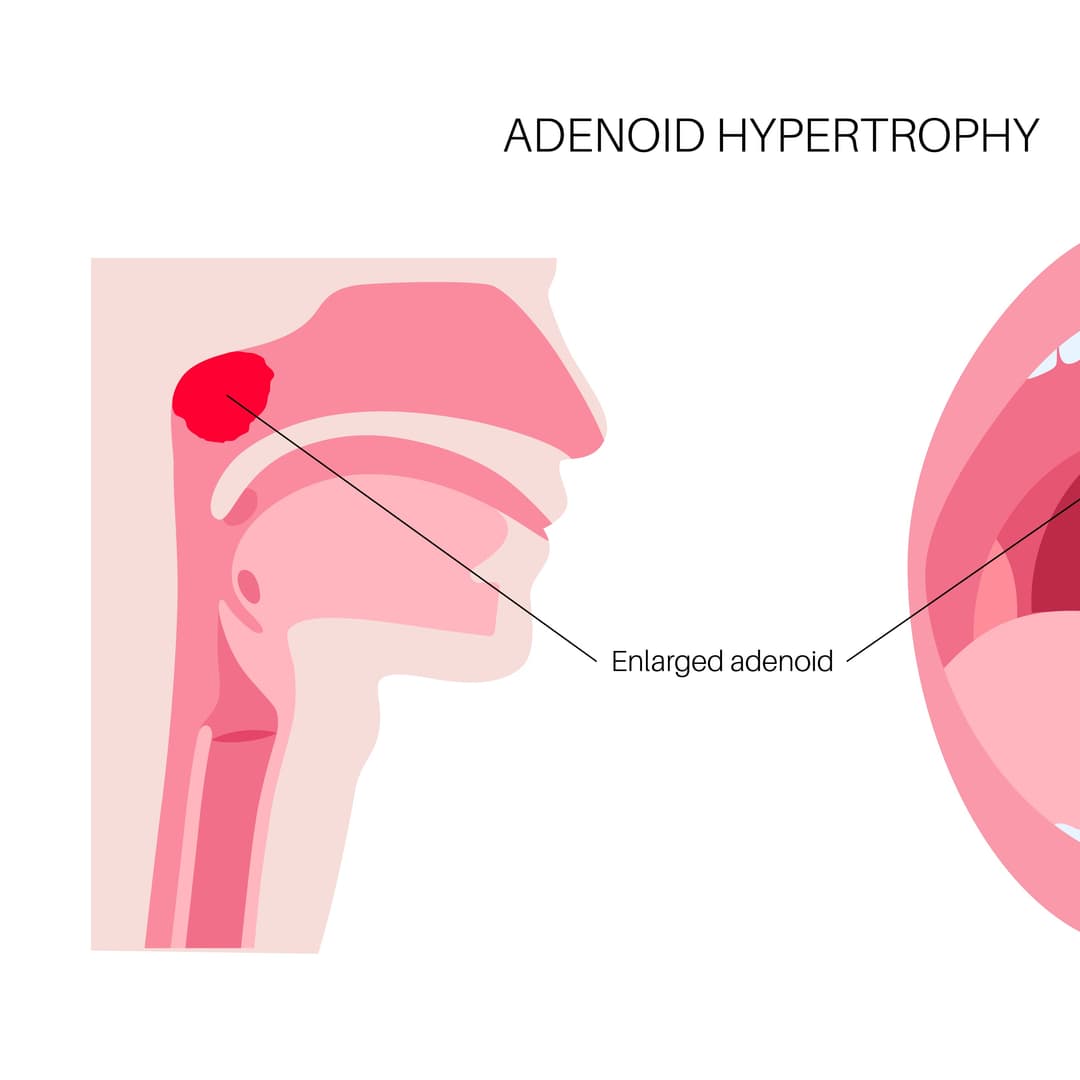 Adenoids