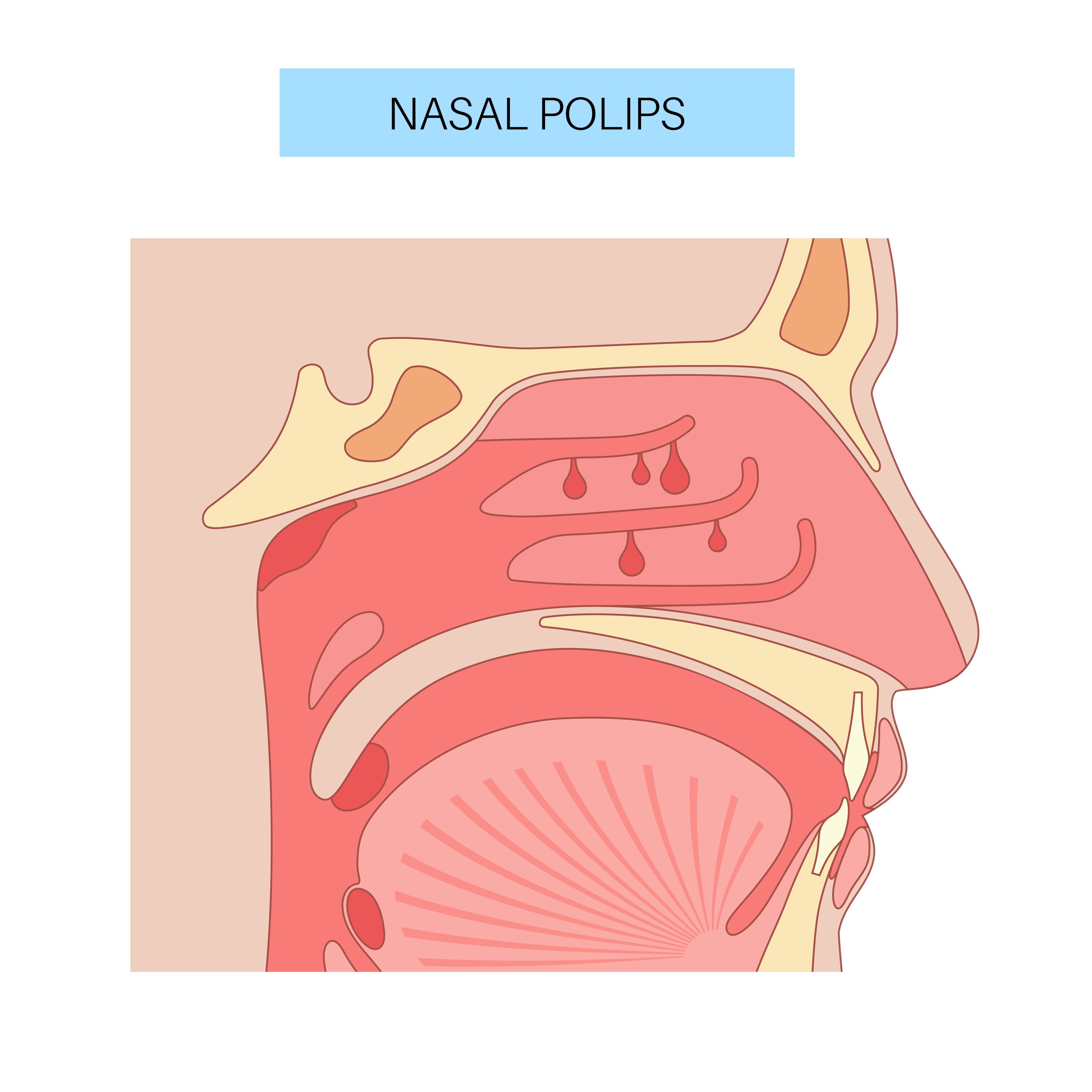 Nasal Polyps