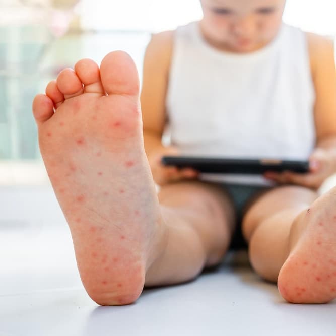 Hand Foot Mouth Disease
